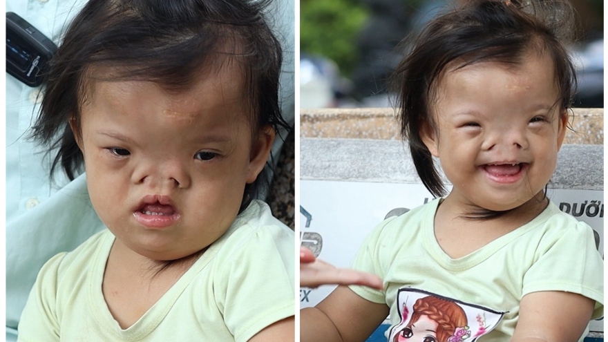 Bé 4 tuổi bị khuyết tật sọ mặt bẩm sinh cần sự giúp đỡ từ cộng đồng